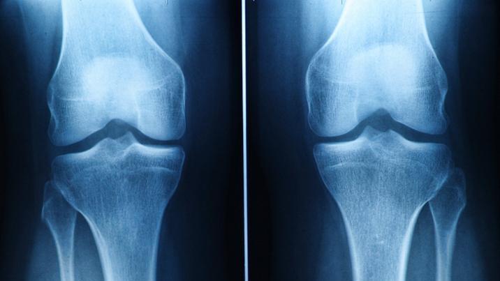‘꿈’ 같던 연골 재생, 현실로? 스탠포드대, 관절염 치료 새 돌파구