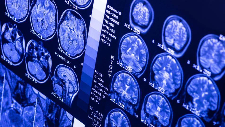 전문가들이 말하는 치매 위험 낮추는 ‘5가지 전략’
