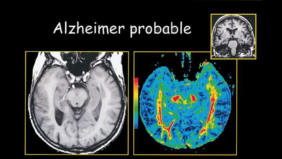 57세에 치매 환자 된 내과 의사 “답은 ‘조기 진단’ 강화”