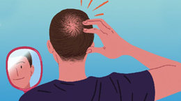 동서고금에 전해지는 탈모 치료법들[이상곤의 실록한의학]〈136〉