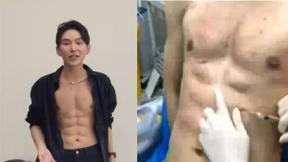 “운동 대신 주사 40번”…8억 들여 인공 복근 만든 中 남성