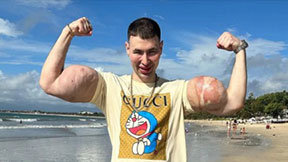 ‘러시아 뽀빠이 男’…과도한 약물 주사로 두 팔 잃을 위기