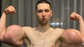 약물로 근육 키운 ‘러시아 뽀빠이’ 양팔 절단 위기