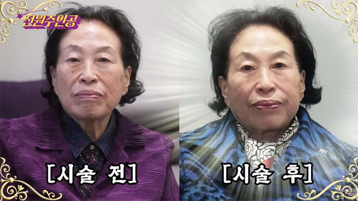 ‘짠돌이’ 전원주, 500만원 피부과 시술…“주름 하나 없이 매끈”