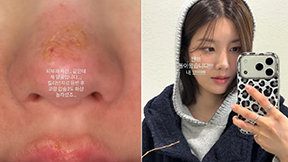 권은비 코·입술에 2도 화상…“새해 등산 도전 했다가”