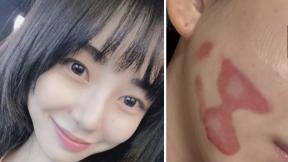 AOA 출신 권민아 “피부 시술로 2도 화상…살 찢어지는 고통”