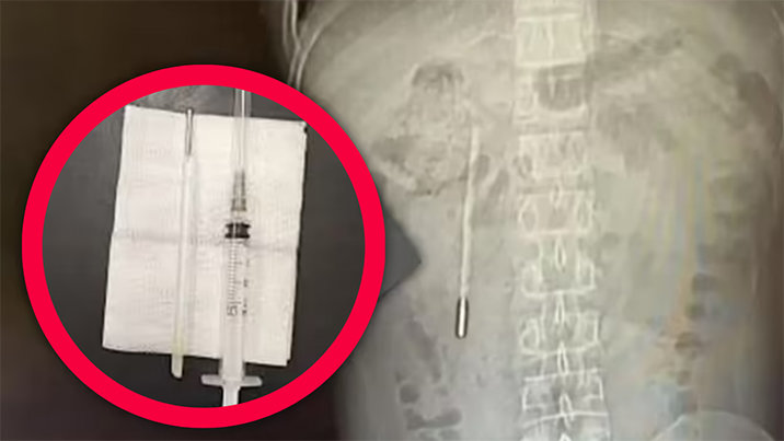 “혼날까봐 말 안해”…20년 전 삼킨 수은 체온계, 배 안에서 발견