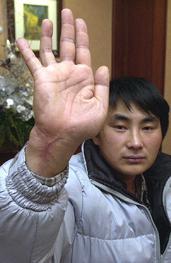유태준씨가 13일 기자회견 도중 북한에서고문을 당해 생긴 손목의 상처를 보여주고 있다