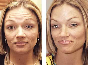 보톡스 시술 전후 변화된 얼굴 모습