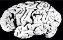 알베르트 아인슈타인의 뇌 사진. 미국의 병리학자 토머스 하비가 촬영한 것으로 화살표 부분은 ‘실비우스 주름’. 이 주름은 일반인의 뇌에서보다 더 크다.    -동아일보 자료사진