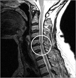 목 디스크 환자의 자기공명영상(MRI)촬영 사진. 목뼈 사이의 수핵이 터져나와 신경을 누르고 있다.-사진제공 삼성서울병원