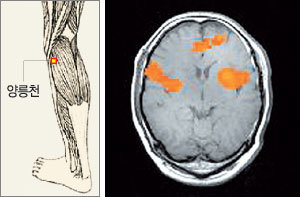 양릉천혈에 침을 놓은 후의 뇌 사진. 정확하게 침을 놓았을 때는 뇌의 운동피질이 활성화되었다.-사진제공 전신수 교수