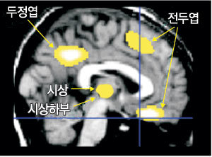 기면증 환자 뇌의 PET 사진. 흰색 부분에서 포도당 대사가 정상인에 비해 크게 떨어지는 것으로 나타났다. 사진제공 삼성서울병원