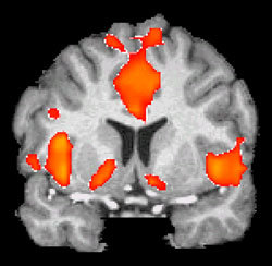 알코올의존 환자에게 술병을 보여줬을 때 뇌의 변화를 기능자기공명영상(fMRI)으로 촬영한 장면. 쾌락중추, 그리고 이로부터 자극을 얻어 의식하는 영역에 혈액이 몰려 활성화돼 있다(점선안). -사진제공 김대진 교수