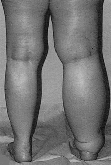 오른쪽 다리가 심하게 림프부종에 걸린 모습. 림프부종은 당장 완치보다 평생 관리한다는 마음가짐이 가장 중요하다. 사진 제공 서울아산병원