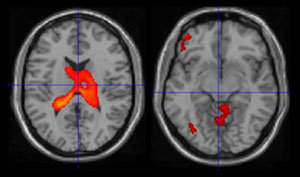 열정적 사랑에 빠진 사람의 뇌(왼쪽)는 ‘사랑의 칵테일’이라고 불리는 신경전달물질인 도파민이 분비되는 부위가 활성화 된다. 6개월이 지나면(오른쪽) 이성적 판단을 좌우하는 전두엽이 활성화돼 연인을 볼 때 씌웠던 ‘콩깍지’가 벗겨진다. 사진 제공 KBS