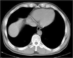 컴퓨터단층촬영(CT)으로 환자의 심장을 찍은 사진. 원 안의 흰 줄이 심장동맥 속에 있는 철사.