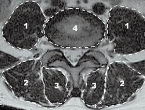 척추 횡단면 MRI에서의 척추 주위 근육. 1은 요근, 2는 기립근, 3은 다열근, 4는 척추체. 사진 제공 서울아산병원