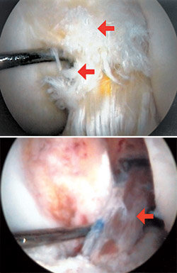 전방십자인대가 파열돼 머리카락처럼 풀어져 있는 관절경 사진(상). 인대 재건 수술이 끝난 다음 전방십자인대가 제모습을 찾은 사진. 사진 제공 세종병원
