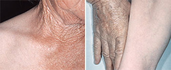 70세 노인의 목과 어깨, 손과 팔 부위의 주름 정도엔 큰 차이가 있다. 학계에서는 자외선의 영향 때문으로 보고 있다. 사진 제공 서울대병원