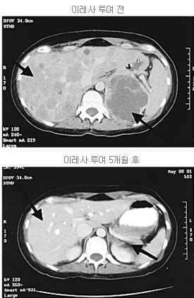 항암화학치료에서 효과가 없었던 40대 비소세포성 여성 폐암 환자의 암세포(오른쪽 아래 화살표)가 이레사를 복용하고 5개월 뒤 크게 줄었다. 사진 제공 삼성서울병원