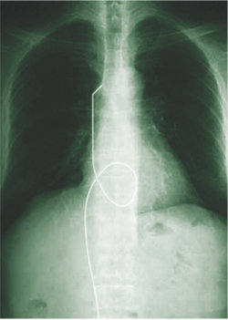 가슴 X선 사진에서 환자의 혈관 속에 들어 있는 철사가 흰 선으로 뚜렷하게 보인다. 사진 제공 권신애 변호사