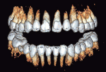 64채널 CT의 영상을 이용해 3차원으로 복원한 미라의 치아. 사진 제공 고려대