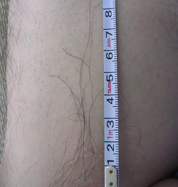 황성주 원장이 자신의 머리털을 뽑아 다리에 심은 뒤 잘 자라고 있는 것을 찍은 사진.