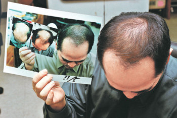 탈모 치료법은 원인과 증상에 따라 다르지만 크게 미녹시딜 등의 약 복용, 주사요법 ‘메조테라피’, 모발이식 등으로 나뉜다. 40대 탈모 환자가 치료를 받고 호전되는 모습. 동아일보 자료 사진