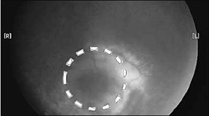 안저사진에 나타난 포도막 흑생종 모습.