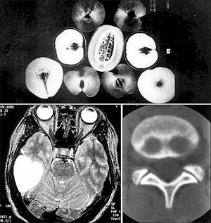연세대 정태섭 교수는 의료용 진단장비로 촬영한 독특한 사진을 모은다. 위는 과일의 MRI 사진, 아래 왼쪽은 염증 조직이 하트처럼 찍힌 뇌의 CT 사진, 오른쪽은 돼지 코 모양이 나타난 척추의 CT 사진. 사진 제공 정태섭 교수