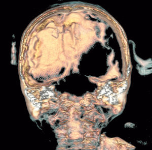 소년 미라의 뇌 촬영 사진. 다른 나라 미라와 달리 한국 미라는 머리 속에 뇌조직이 남아 있는 것이 확인됐다. 사진 제공 단국대 의대 이인선 교수