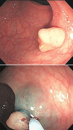 대장에 난 선종(위)을 혹이 시작되는 오목한 부위에 철사를 감고 열을 가해 잘라내고 있다(아래).