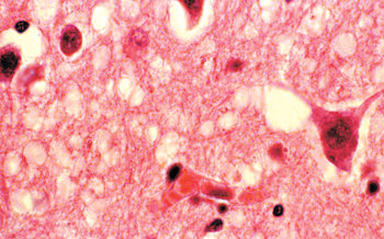 크로이츠펠트야코프병에 걸린 사람의 뇌 조직. 구멍(흰 부분)이 숭숭 뚫려 있다. 사진 제공 GAMMA