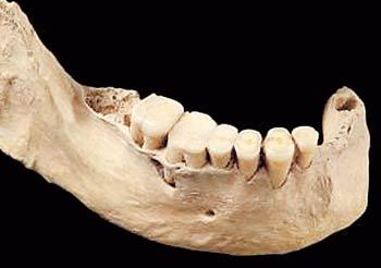 중국 베이징 저우커우뎬 유적에서 서남쪽으로 6km 떨어진 톈위안 동굴에서 발굴된 유골에 이가 가지런히 붙어 있다. 사진 출처 베이징만보
