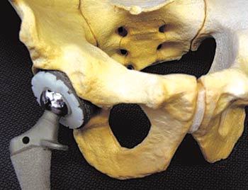 움직일 때 마모가 일어나지 않도록 방사선을 쪼여 만든 인공관절. 사진 제공 한국원자력연구원 정읍방사선과학연구소