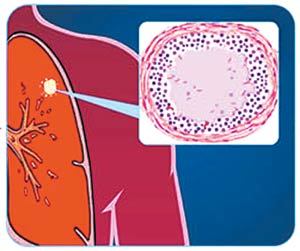잠복 결핵대식세포와 T림프구가 결핵균을 죽이지 못할 경우 남은 결핵균은 육아종(붉은 점들) 속에서 잠복하게 된다. 사진 제공 질병관리본부