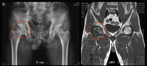 X-ray에는 발견되지 않으나, MRI검사에서 오른쪽 대퇴골두 괴사가 진행되고 있는 모습을 확인할 수 있다.