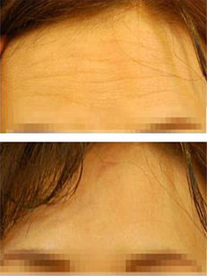 △ 보톡스를 이용한 쁘띠주름성형 시술 전(上)과 시술 후(下)