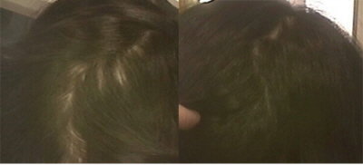 여성탈모 치료 전 후 사진-가로세로한의원 제공