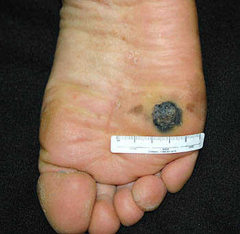 환자의 발에 발생한 악석흑색종의 모습. 동아사이언스