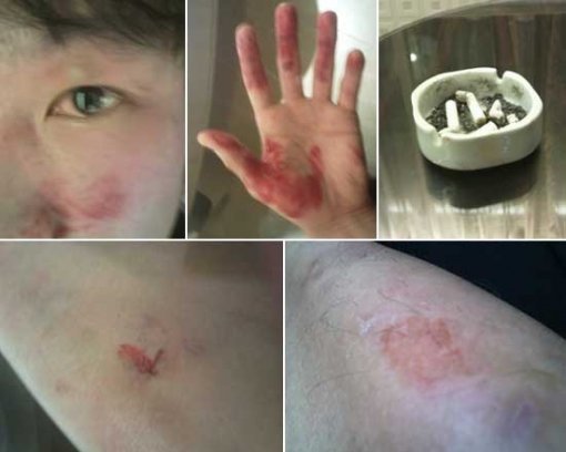 경기력 향상을 위해 해외전지훈련을 떠난 펜싱국가대표팀에서 벌어진 A코치(33)의 김승구(27, 화성시청) 폭행 사건이 결국 대한체육회 선수권익보호팀의 조사를 받게 됐다. 사진은 폭행당했다고 주장하는 사건 직후 김승구의 모습. 윗줄 맨 오른쪽 사진은 사건 당시 폭행도구로 사용된 재떨이 증거사진. [사진=김승구 제공]