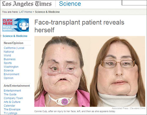 미국 최초 얼굴중앙 대부분 이식수술성공2004년 총격으로 얼굴 중앙부분 대부분을 손상 당한 두 아이의 엄마 코니 컬프 여사(46)가 작년12월 오하이오 클리블랜드 클리닉에서 미국에서는 최초로 얼굴이식수술을 성공적으로 받고 5일 병원에서 기자회견을 가졌다. 사진은 컬프여사의 얼굴이식수술전후 모습. [출처=LA타임즈 홈페이지 캡처]