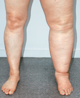 다리가 붓는 이유는 천차만별이다. 원인을 알아내야 적절한 치료를 받을 수 있다. 사진 제공 연세SK병원