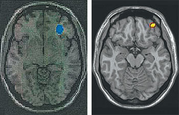 일반인에 비해 활동성이 높은 코카인 중독자의 대뇌 영역(왼쪽 사진)과 일반 사용자에 비해 활동성이 높은 인터넷 게임 과다 사용자의 대뇌 영역(오른쪽 사진). 유사한 부위의 뇌 기능이 떨어졌다는 것을 보여준다. 사진 제공 분당서울대병원