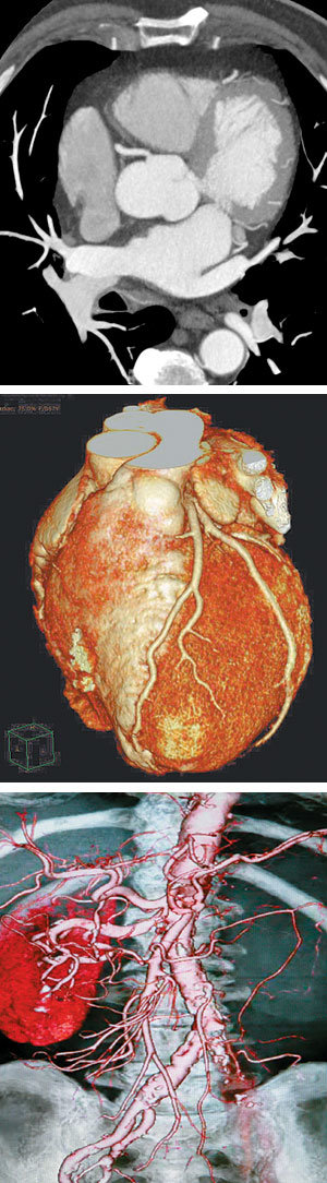 기존의 2D 컴퓨터단층촬영(CT·위쪽) 사진에서는 심장의 형태와 혈관이 희미하게 나와 환자가 이해하기는 어려웠다. 그러나 3D CT로 찍은 심장 사진(가운데)은 심장의 전체적인 형태를 입체적으로 보여줘 환자도 알아볼 수 있다. 심장 주변을 3D로 찍은 아래쪽 사진에서 심장(왼쪽 둥근 부분), 심장과 연결된 관상동맥 혈관을 선명하게 확인할 수 있다. 사진 제공 필립스 헬스케어·세종병원