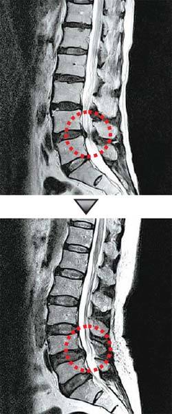 수술 전(위) - 신경이 내려가는 척추관이 좁아져 신경이 눌려 있다.
수술 후(아래) - 수술로 좁아진 척추관을 넓혀 신경이 원 상태로 돌아왔다.