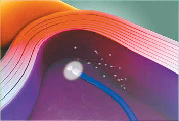 플라스마 치료기를 이용해 추간판(디스크) 내부에서 염증을 치료하는 모습. 플라스마는
에너지가 높아 인체조직은 물론 세균, 바이러스 등을 깨끗하게 제거할 수 있다. 사진 제공 고려대 의대