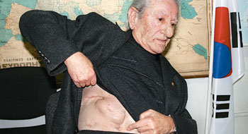 6·25전쟁 당시 복부 관통상을 당한 알렉산드로스 카라차스 씨가 수술 흔적을 보여주고 있다. 카라차스 씨는 부상으로 7년간 11차례나 수술을 받아야 했다.