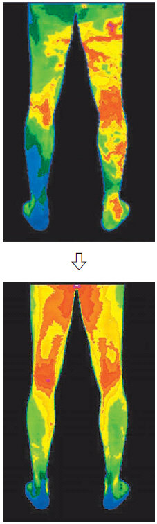 환자의 다리를 적외선체열검사기로 촬영한 결과 시술 전엔 왼쪽 다리로 내려가는 신경이 눌리며 혈액이 잘 돌지 않아 종아리 쪽이 파랗게 보인다.(위) 시술후엔 왼쪽 종아리가 오른쪽과 같이 정상으로 돌아왔다. 사진제공 고도일병원